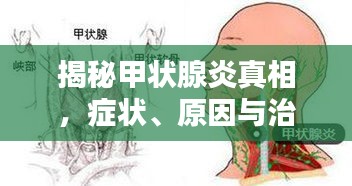 揭秘甲状腺炎真相,症状、原因与治疗方法全解析!
